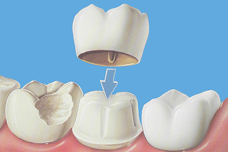 Crowns-2015-Dra-Emma-Periodoncia-Mexicali 