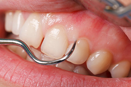 Encias-2015-Dra-Emma-Periodoncia-Mexicali 